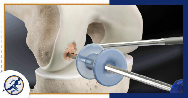 Estimulación médula ósea – Cirugía Articular Quito